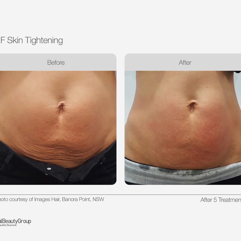RF_Skin_Tightening_Before_After_02