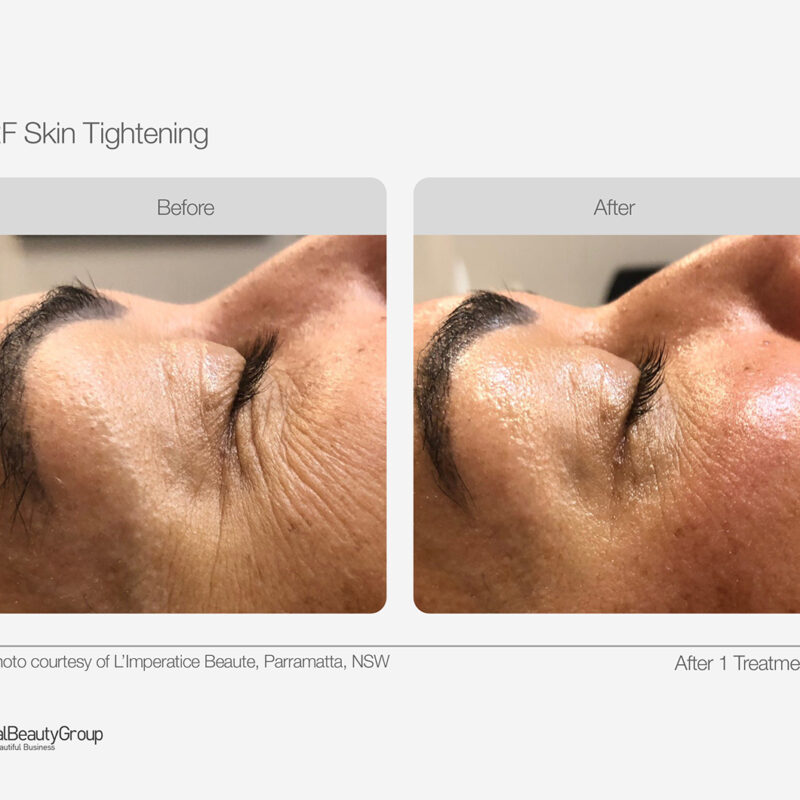 RF_Skin_Tightening_Before_After_03