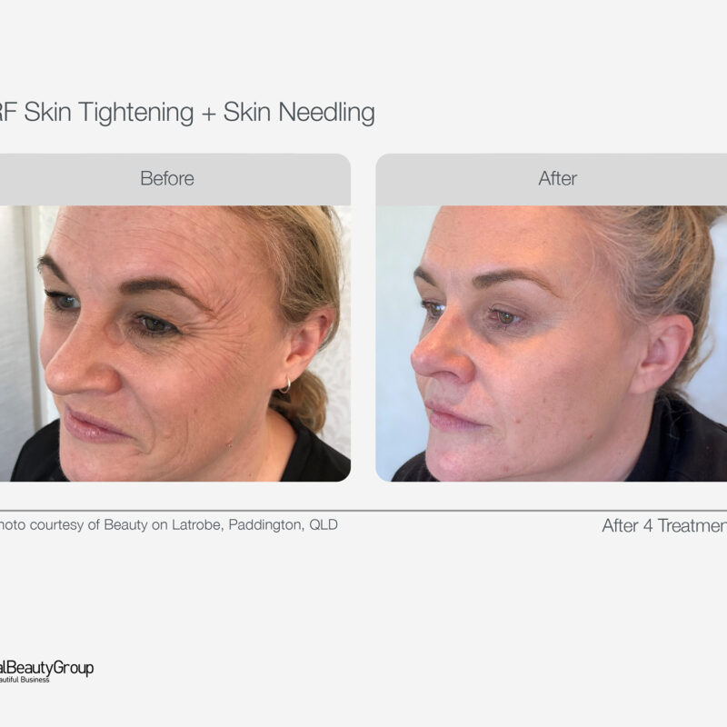 RF_Skin_Tightening_Before_After_06