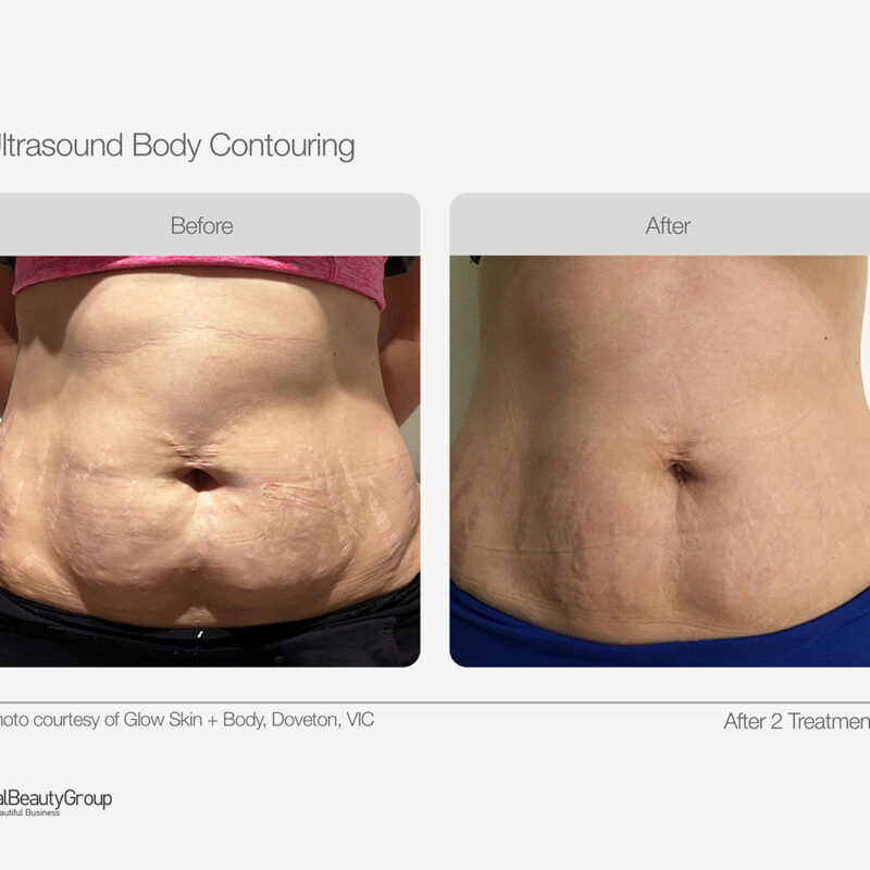 Ultrasound_Body_Contouring_Before_After_08