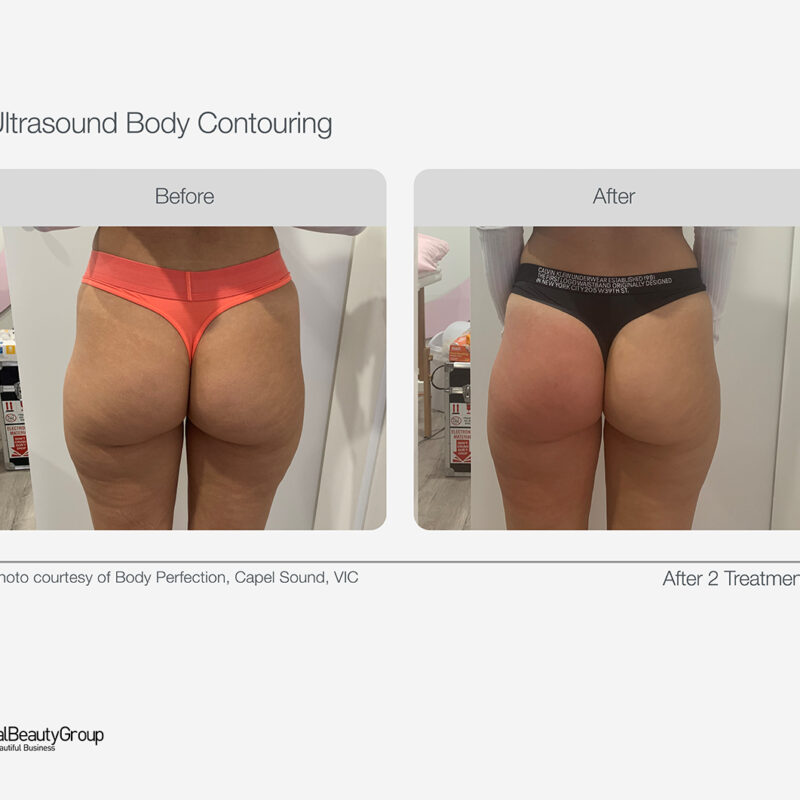 Ultrasound_Body_Contouring_Before_After_17