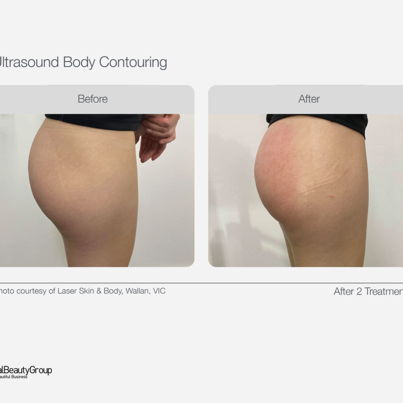 Ultrasound_Body_Contouring_Before_After_25