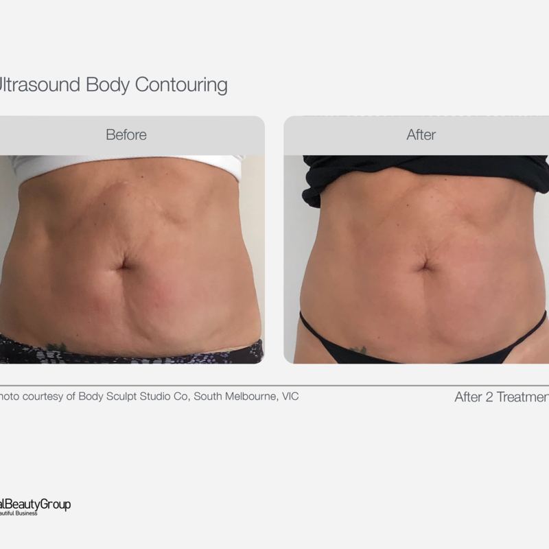Ultrasound_Body_Contouring_Before_After_28