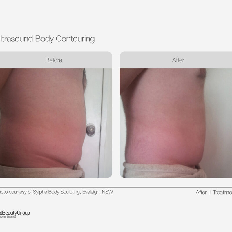 Ultrasound_Body_Contouring_Before_After_02