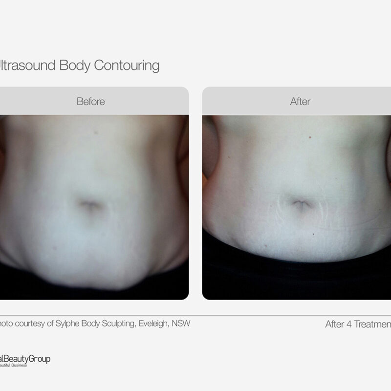 Ultrasound_Body_Contouring_Before_After_03