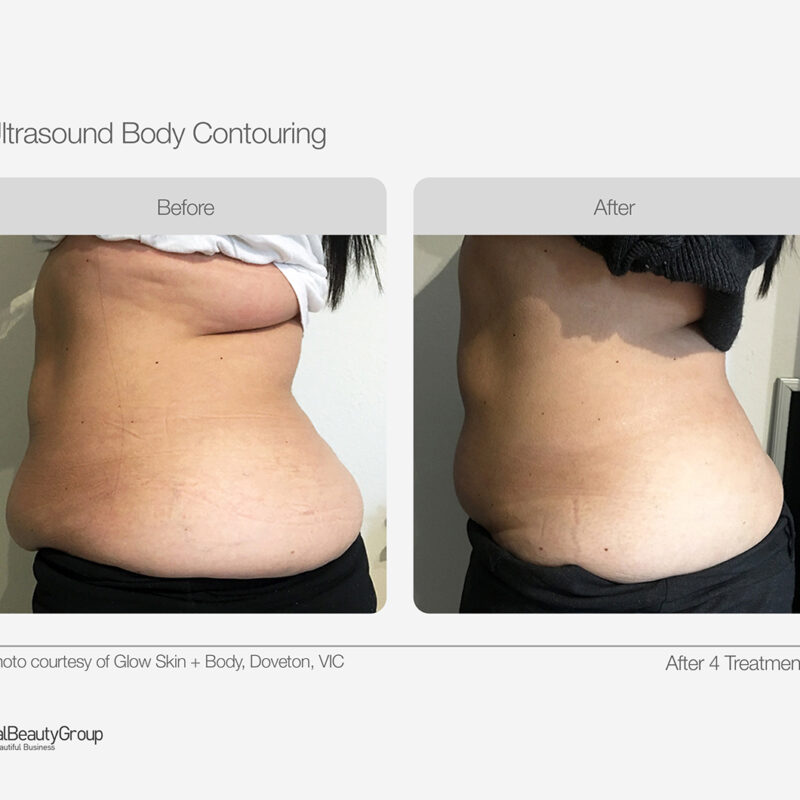 Ultrasound_Body_Contouring_Before_After_13